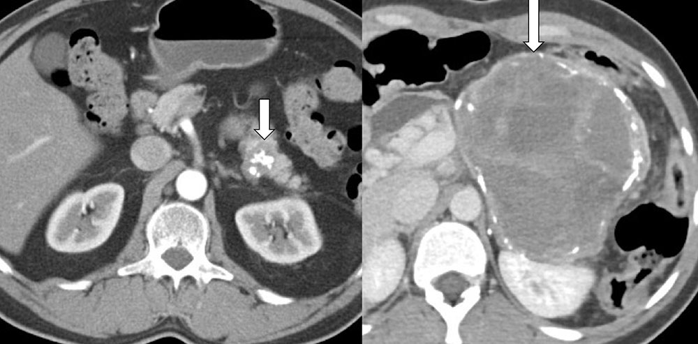 Solid and PseudopapillaryNeoplasm