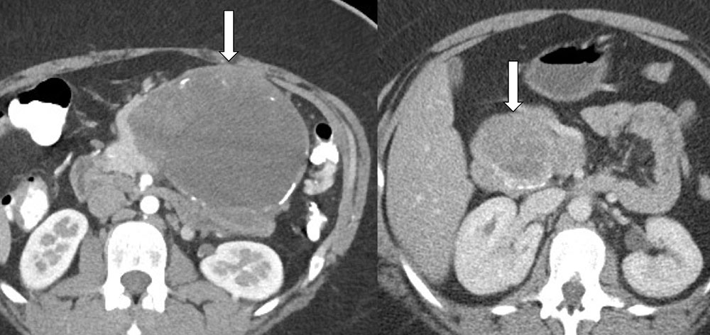 Solid and PseudopapillaryNeoplasm