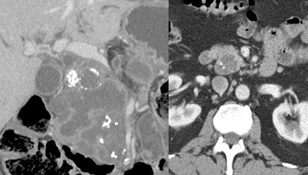 Intraductal Papillary Mucinous Neoplasm (IPMN)