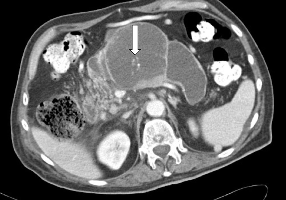 Intraductal Papillary Mucinous Neoplasm (IPMN)