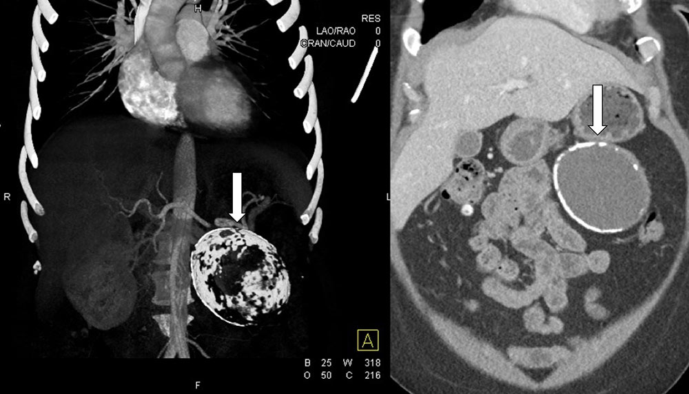 Pancreatic Pseudocyst