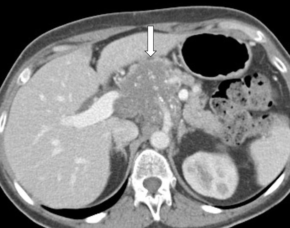 Pancreatic Metastasis