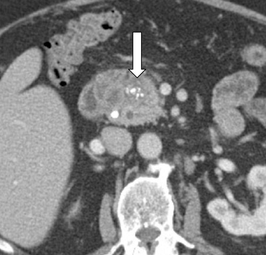 Pancreatic Metastasis