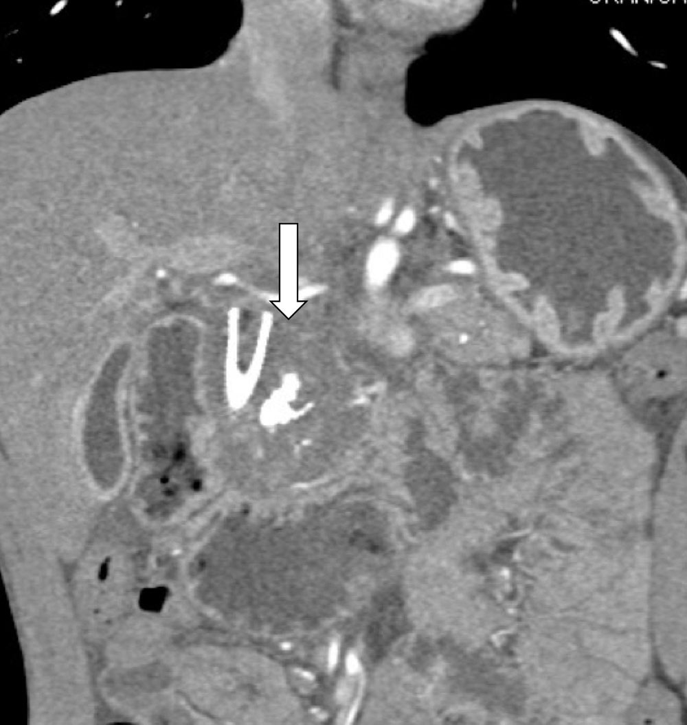 Chronic Pancreatitis