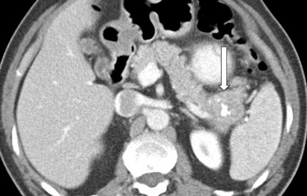 Pancreatic Neuroendocrine Tumor