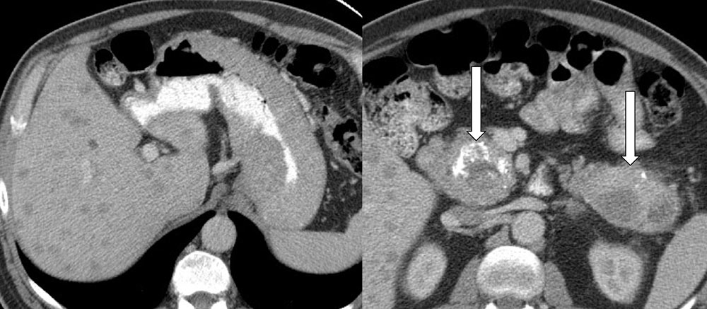 Pancreatic Neuroendocrine Tumor