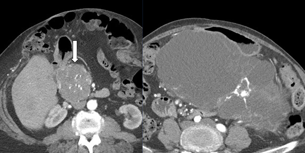 Serous Cystadenoma