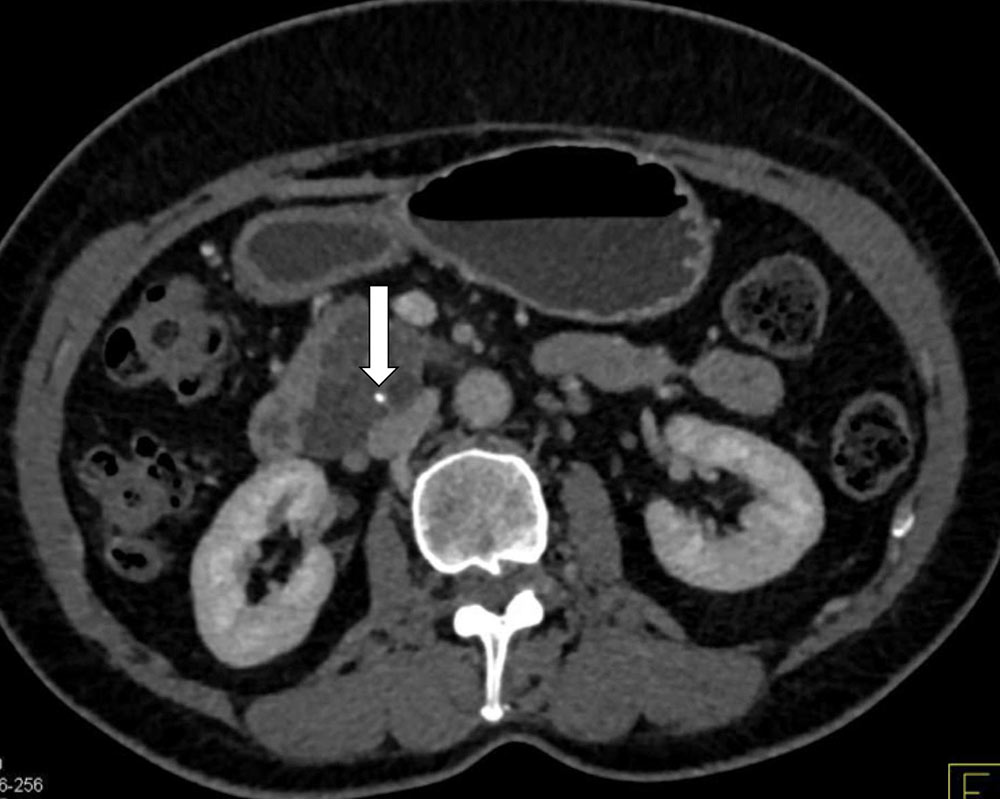 Serous Cystadenoma