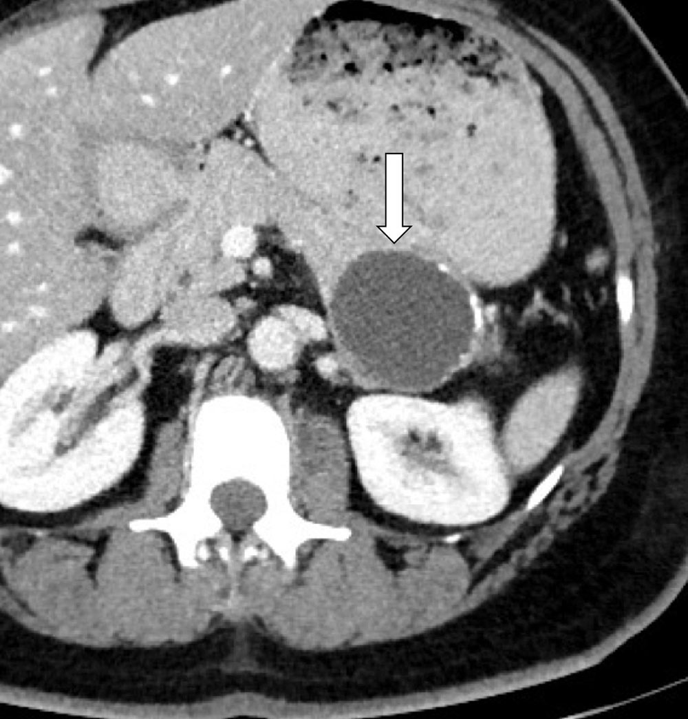 Mucinous Cystic Neoplasm