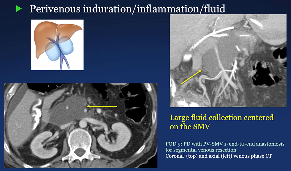Perivenous space:  Induration/inflammation/fluid on CT after PVR