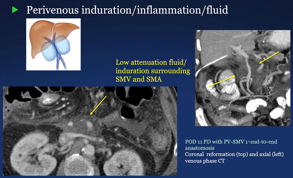Perivenous space:  Induration/inflammation/fluid on CT after PVR