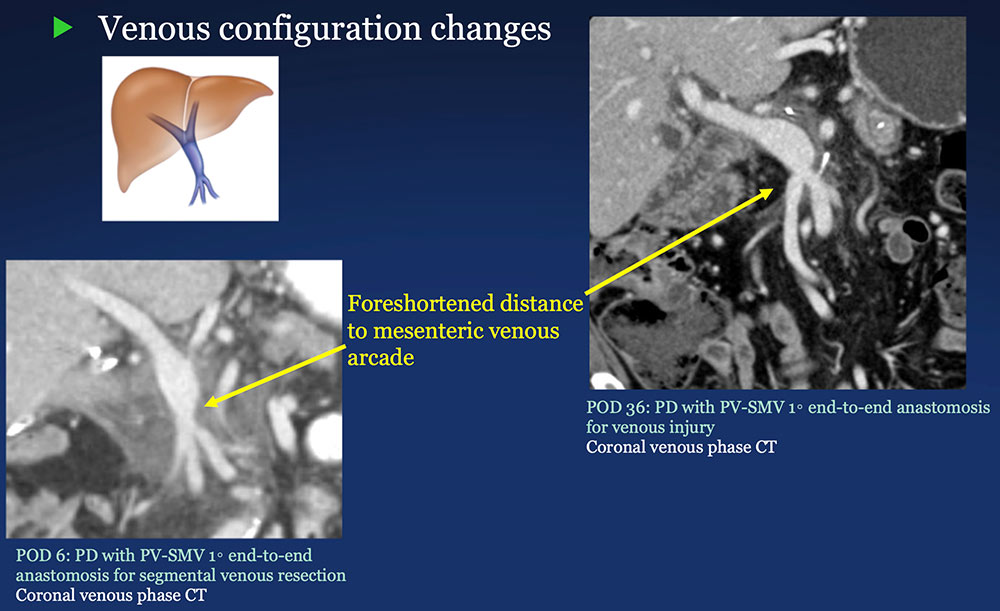 PV-SMV: Venous configuration changes on CT after PVR