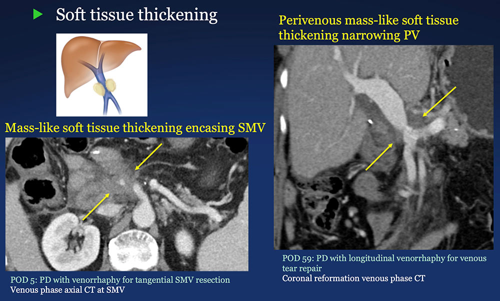 Perivenous space:  Perivenous ST thickening on CT after PVR