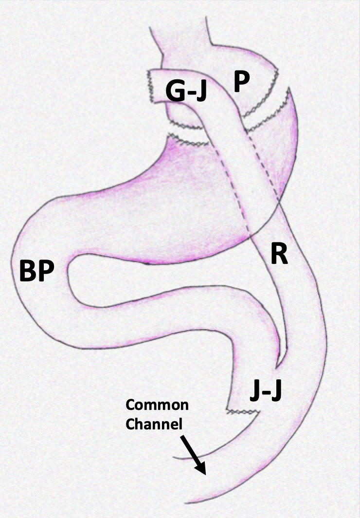 RYGB Procedure