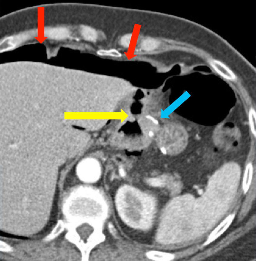 Marginal Ulcers