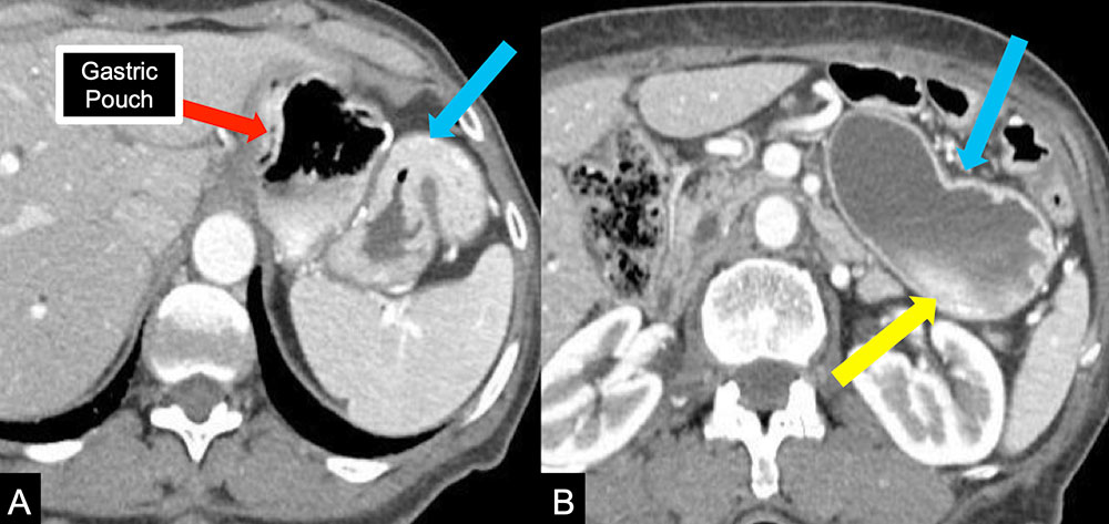 Gastrogastric Fistula