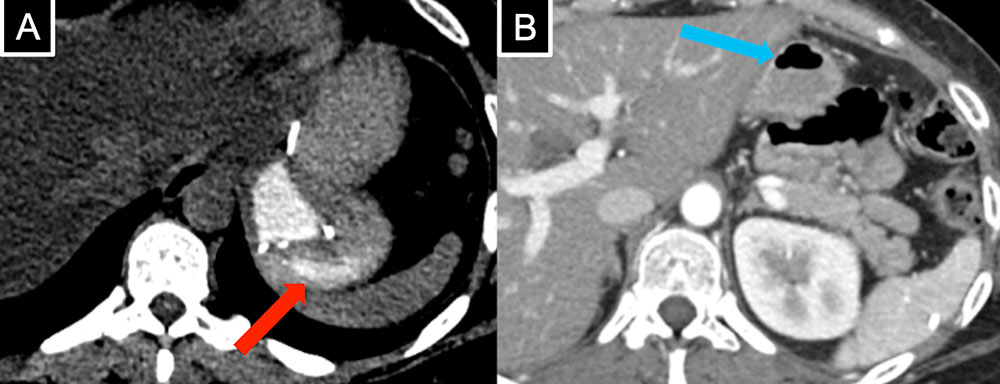 Gastrogastric Fistula