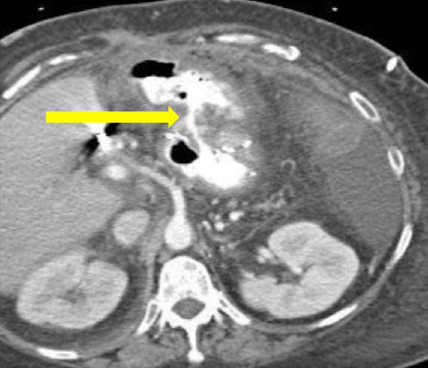 Gastrogastric Fistula