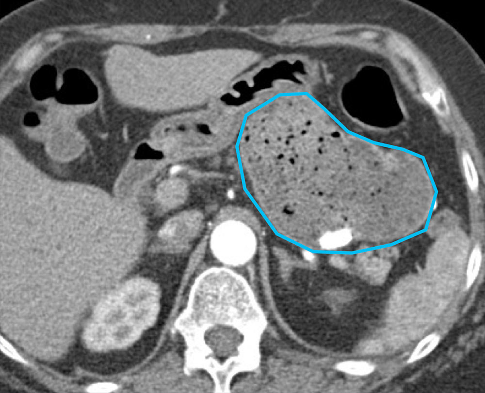 Gastric Pouch Dilatation