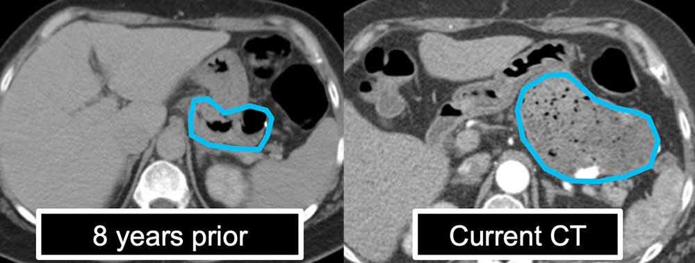 Gastric Pouch Dilatation