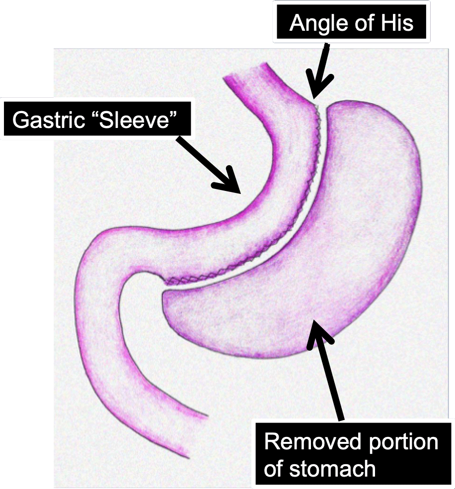 Vertical Sleeve Gastrectomy (VSG)