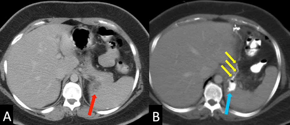 Anastomotic Leak