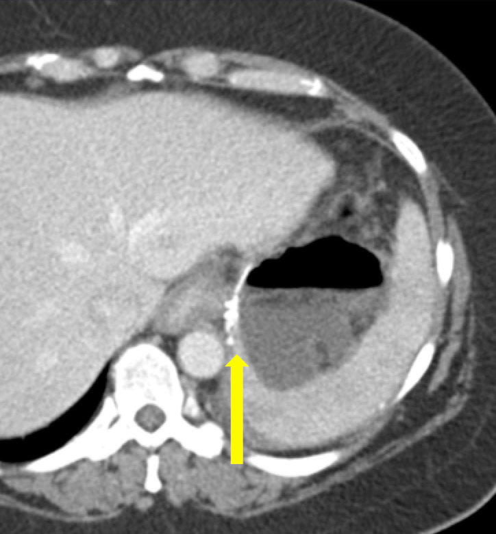 Anastomotic Leak