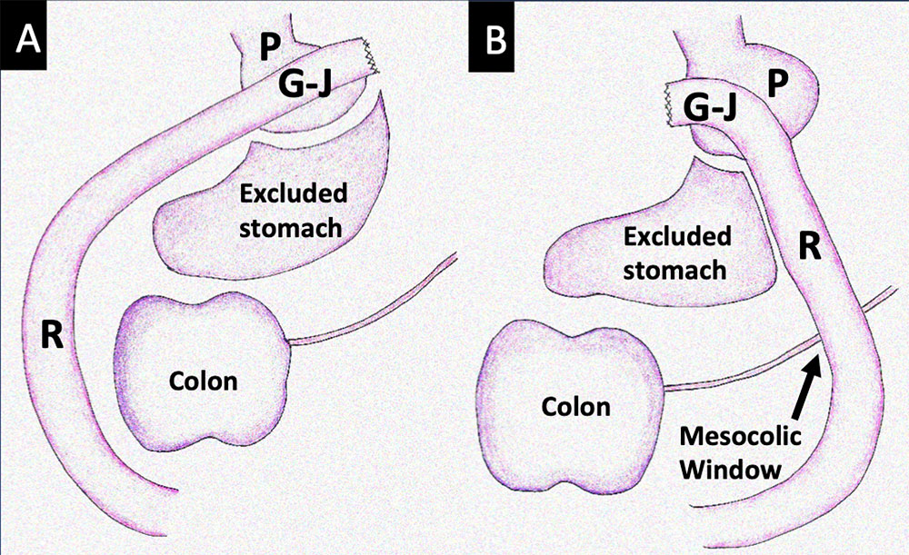 RYGB Procedure