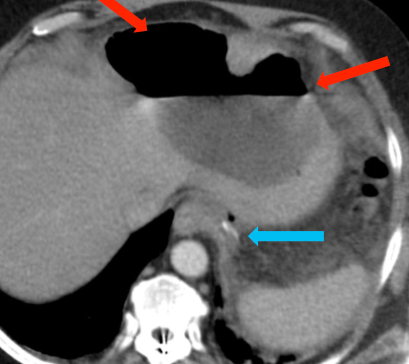 Anastomotic Leak