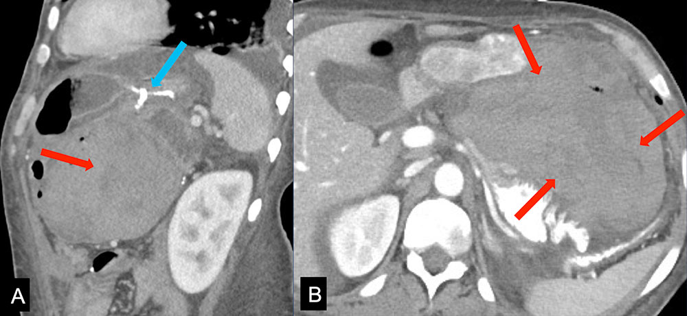 Mesenteric Hematoma Post RYGB