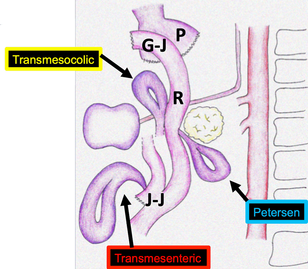 Internal Hernia