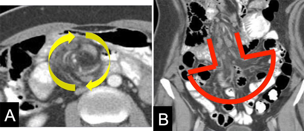 Internal Hernia