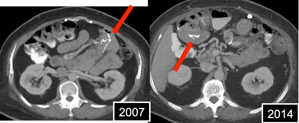 Internal Hernia