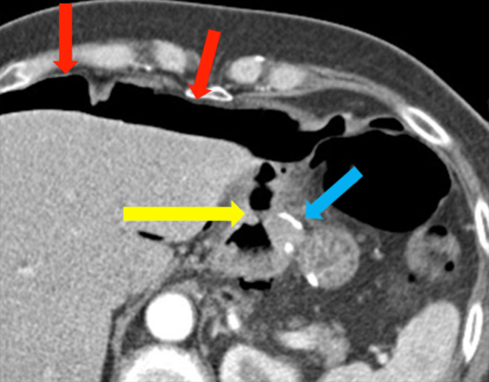 Perforated G-J Marginal Ulcer