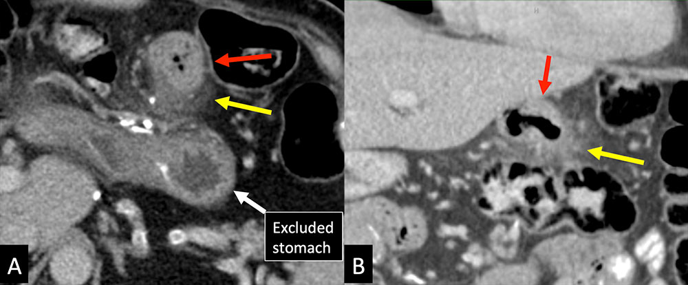 Companion Case – G-J Ulcer