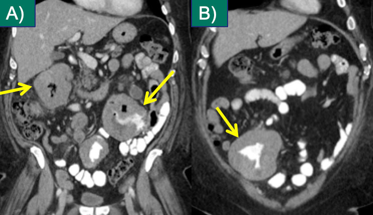 Small Bowel