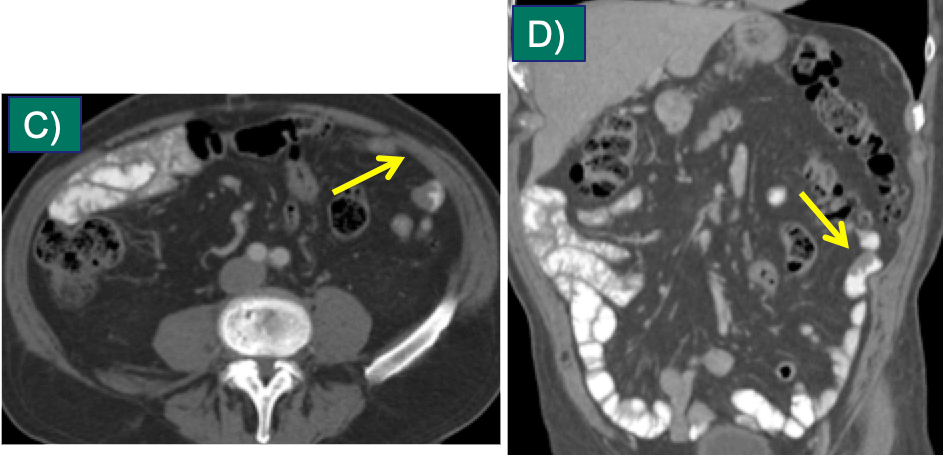 Small Bowel