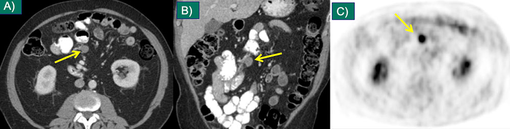 Mesenteric Metastasis