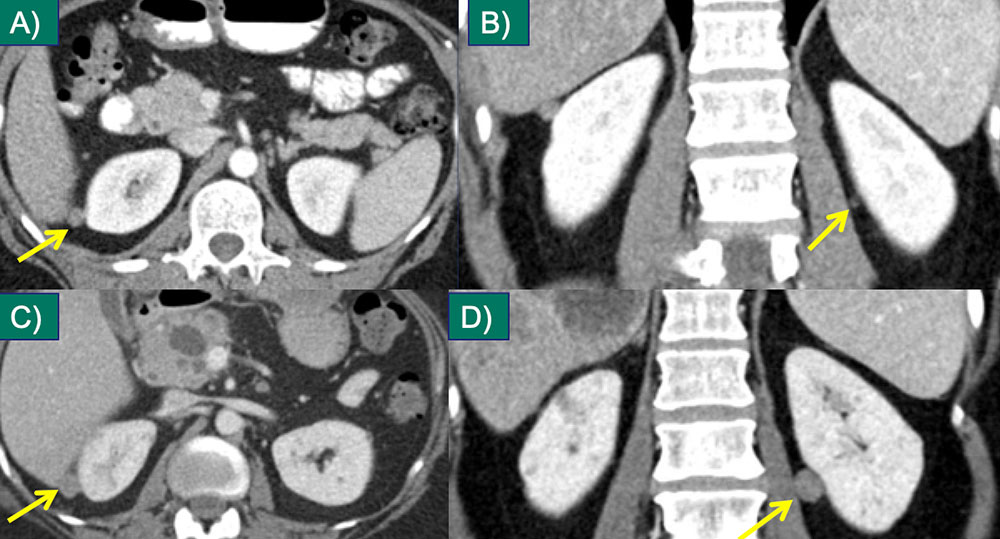 Perinephric Metastasis