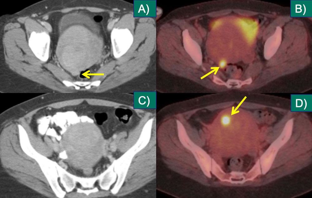 Uterine Metastasis