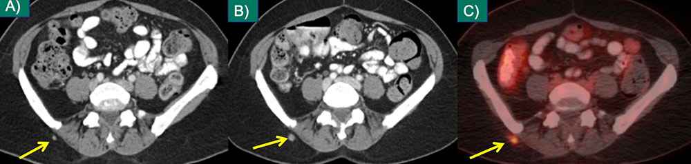 Isolated Subcutaneous Metastasis