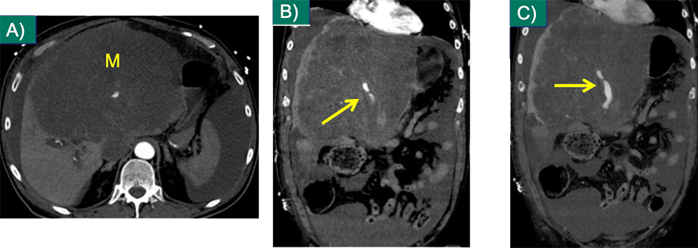 Complications of Melanoma Mets