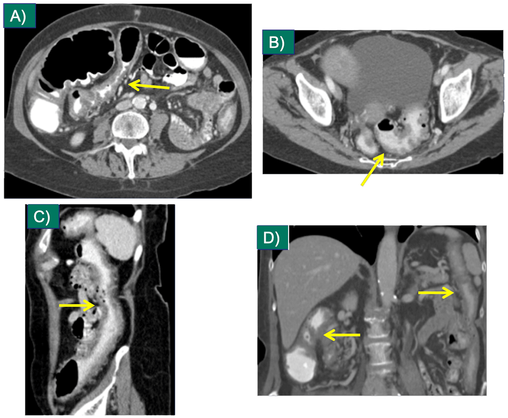 Immunotherapy Complications