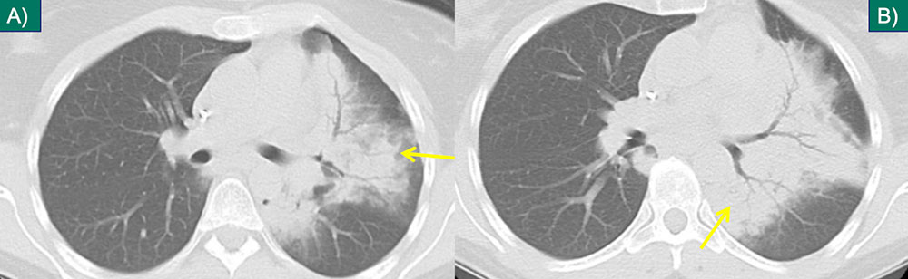 Immunotherapy Complications