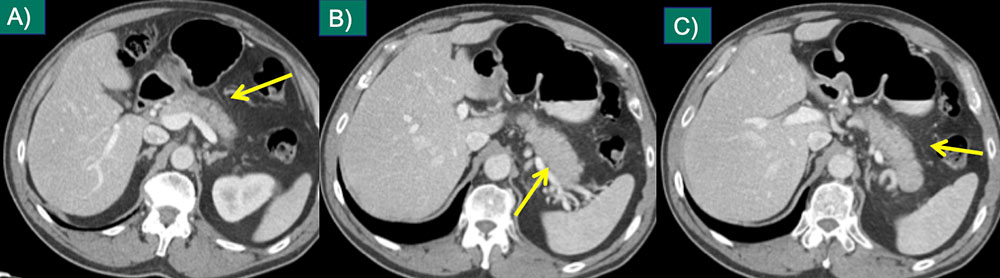 Immunotherapy Complications