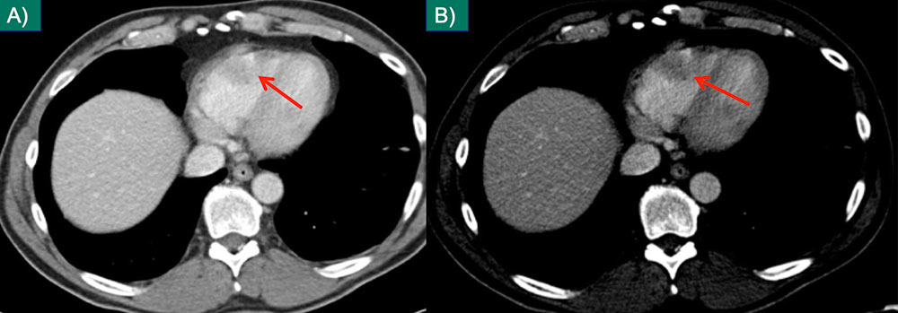 Cardiac Metastasis