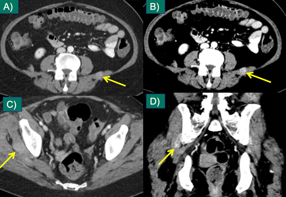 Intramuscular Metastases