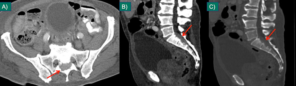 Spinal Canal