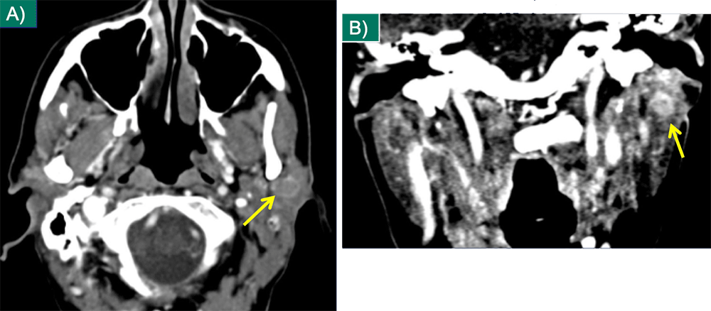 Parotid Metastasis