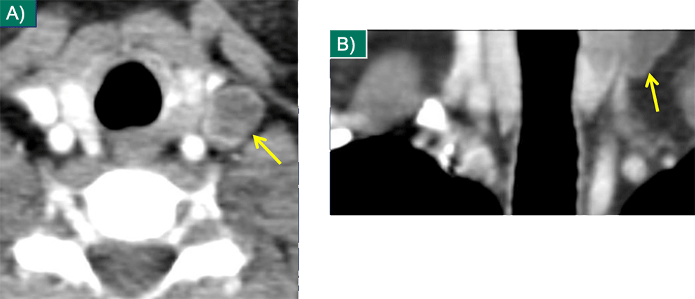 Thyroid Metastasis